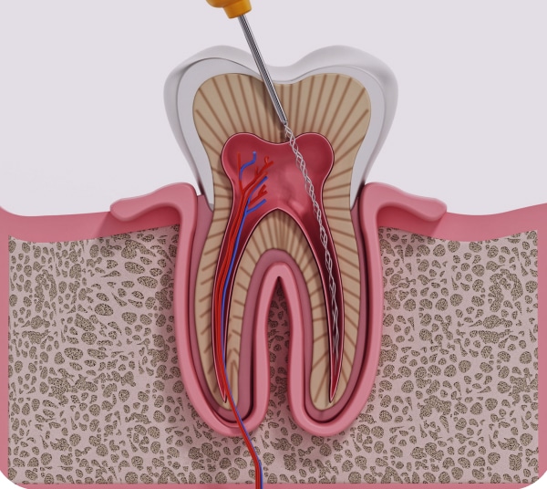 3d illustration root canal treatment process 1
