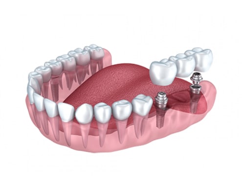 dental implants surgery 3d rendering 1