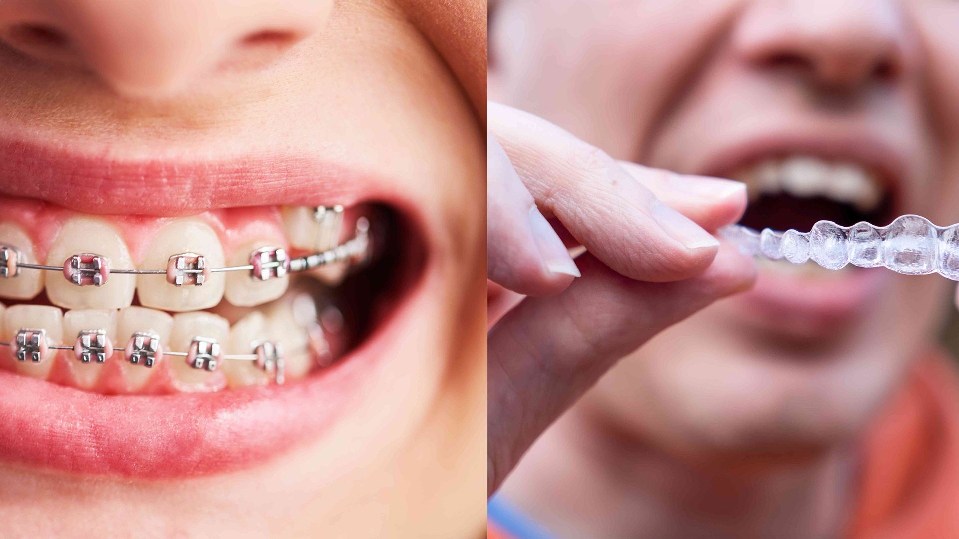 Invisalign vs. Traditional Braces Which Is Right for You