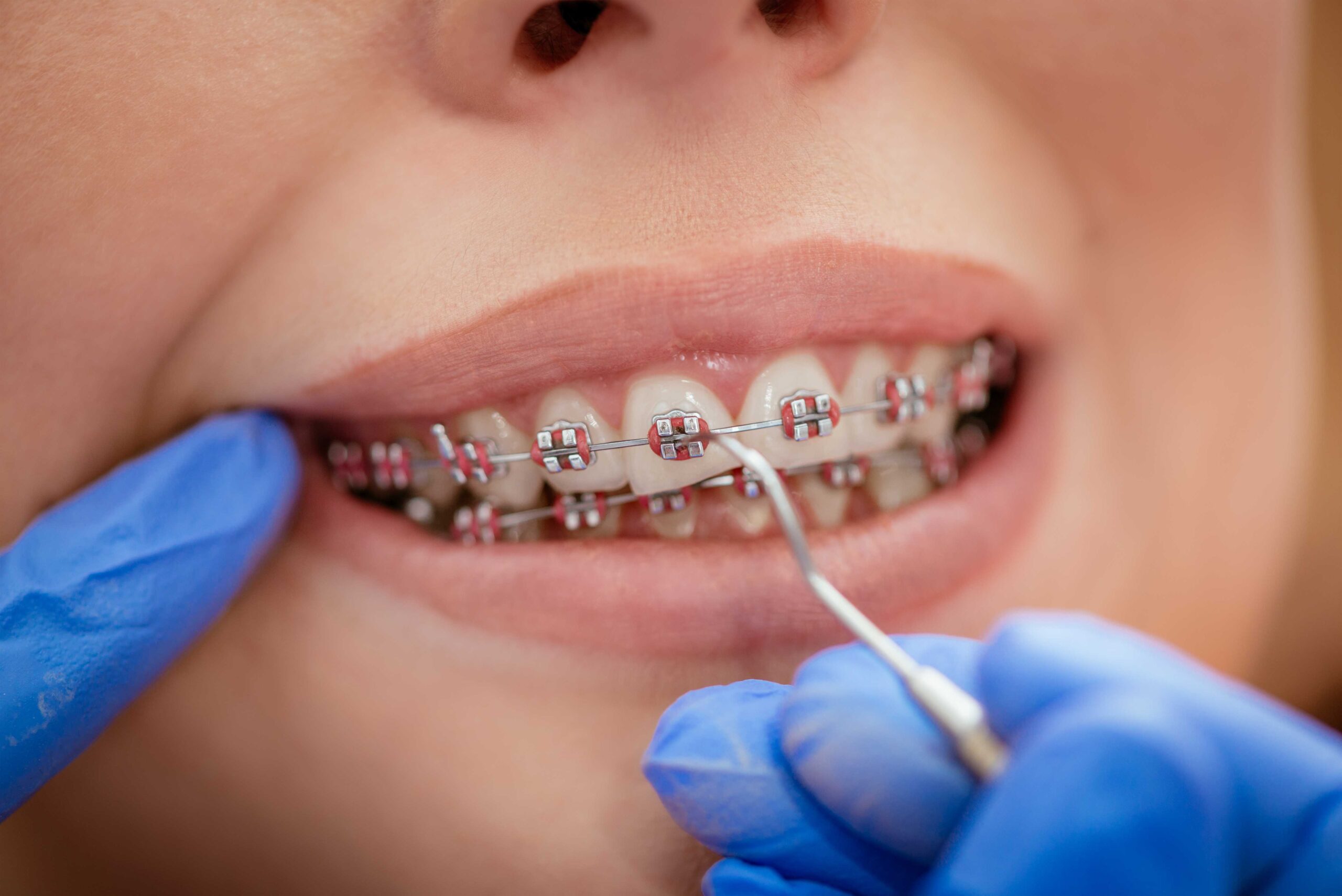 Invisalign over traditional braces scaled