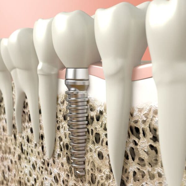 illustration of dental implant in between real teeth